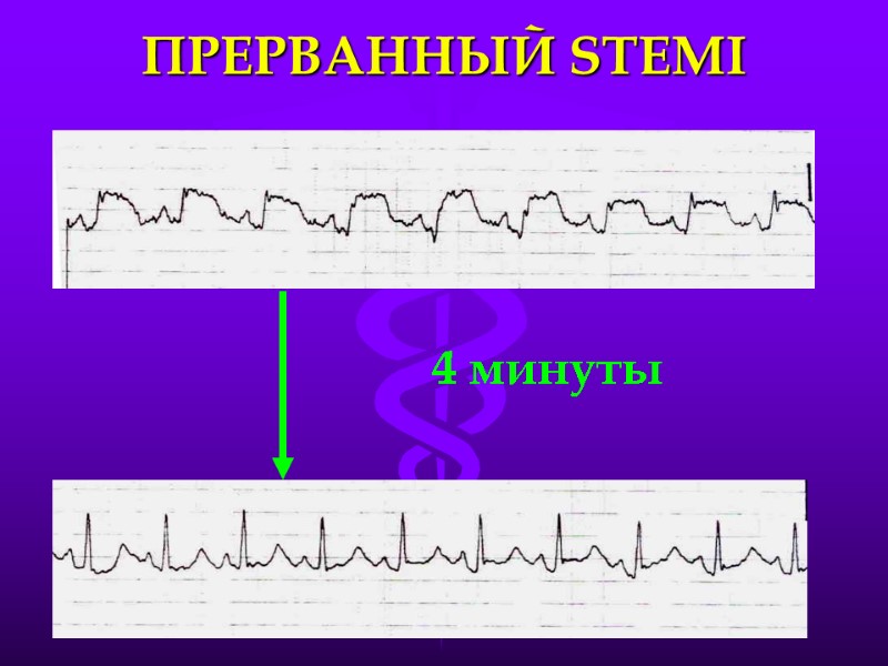 ПРЕРВАННЫЙ STEMI 4 минуты